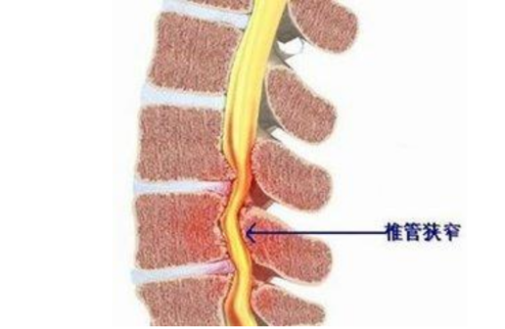 北京济和堂：椎管狭窄骨科疾病如何护理